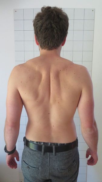 Nach hinten gezogene Schultern - Behandlung durch Pohltherapie