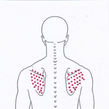 Schulterschmerzen auf den Schulterblättern - Behandlung durch Pohltherapie