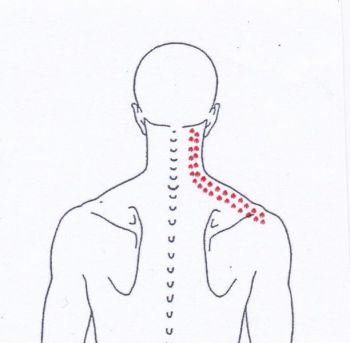 Schulterschmerzen oben auf der Schulter - Behandlung durch Pohltherapie