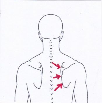Schulterschmerzen unter dem Schulterblatt - Behandlung durch Pohltherapie