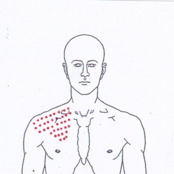 Schulterschmerzen außen an der Schulter - Behandlung durch Pohltherapie