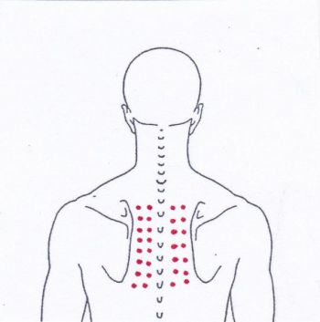 Schulterschmerzen zwischen den Schulterblättern - Behandlung durch Pohltherapie