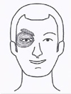 Augenschliessmuskel - Behandlung durch Pohltherapie