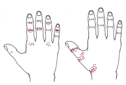 Fingergelenks-Arthrose - Behandlung durch Pohltherapie