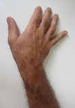 Geknicktes Handgelenk - Behandlung durch Pohltherapie
