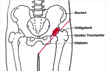 Leistenschmerzen Leistenbruch Meistens Nicht Die Ursache