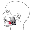 Massetermuskel an der Wange außen als Ursprung von Zahnschmerzen im Unterkiefer - Behandlung durch Pohltherapie