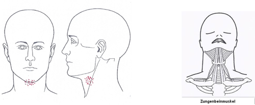 Kloß vorne in der Mitte oft ausgehend von verspannten Zungenbeinmuskeln - Behandlung durch Pohltherapie