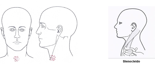 Kloß im Hals unten oft ausgehend von Sternocleidomastoideus-Muskeln - Behandlung durch Pohltherapie