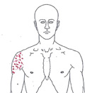 Beschwerden am Oberarm und am ganzen Arm - Behandlung durch Pohltherapie