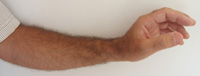 Einwärtsknick zwischen Handrücken und Unterarm - Behandlung durch Pohltherapie