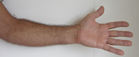 Fingerschmerzen aus den Unterarm - Behandlung durch Pohltherapie