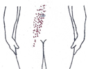 Unterleibsschmerzen können den ganzen Unterleib erfassen - Behandlung durch die Pohltherapie